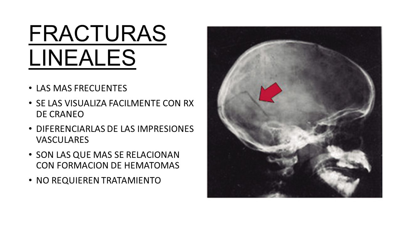 Fractura de cráneo y hematoma subgaleal Fractura de cráneo y hematoma subgaleal